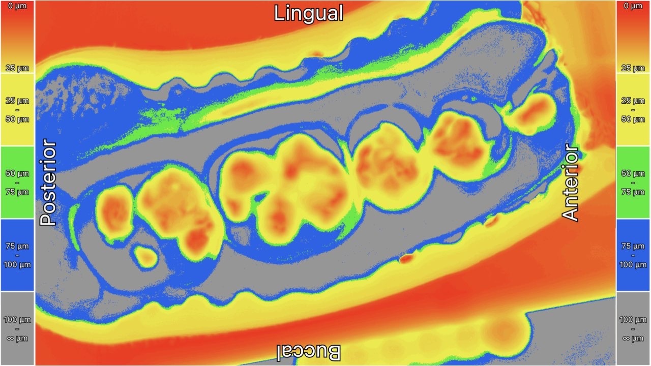 Illuminated occlusal contacts in a segmental arch.