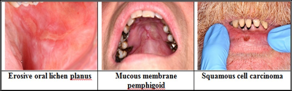 Clinical presentations of oral ulceration
