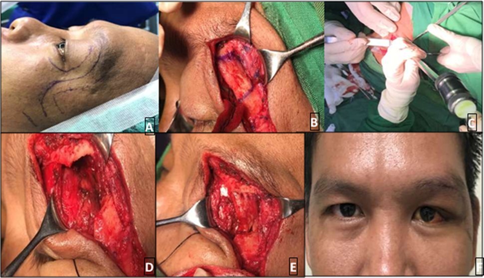 Skin marking of landmarks and incision B. Lateral orbital rim exposed and markings placed C. Osteotomy D. After bone removal, part of the mass is seen E. Lateral orbital rim was repositioned F. Day 11 post-op, grossly there’s marked improvement of previous globe displacement