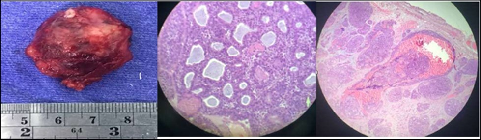 Orbital Mass, left 4B. Cribriform or Swiss-Cheese Pattern 4C. Lymphovascular and perineural invasion