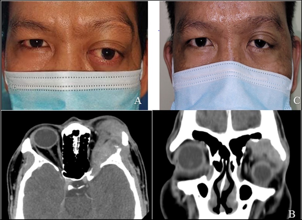 Patient seen two years after the first orbitotomy and tumor excision, with recurrence of mass in the superotemporal orbit and globe displacement. B. Orbital CT scan (axial and coronal sections) revealed a 2.2 x 2.4 x 3.3 cm lobulated, heterogeneously enhancing soft tissue mass seen centered in the left lacrimal gland with few punctate calcifications and associated lytic changes of the adjacent left frontal bone that are suggestive of tumor recurrence C. Four months post-op after repeat orbitotomy and debulking of tumor with chemotherapy