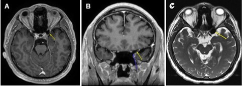 (A) Axial post-gadolinium T1-weighted MRI demonstrating the T1 hypointensity in the left anterior clinoid process (yellow arrow). (B) Coronal post gadolinium T1-weighted MRI with two arrows outlining a clearly delineated air-filled space without a hematoma or traumatic lesion to optic nerve just superior to the tip of blue arrow. (C) Axial T2-weighted FIESTA-C MRI showing T2 hypointensity in the left anterior clinoid process (yellow arrow).