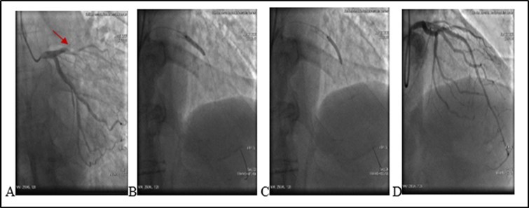(20.06.2020) .A. Occluded stent due to early thrombosis (red arrow). B.C Balloon angioplasty and stenting. D. Final result.