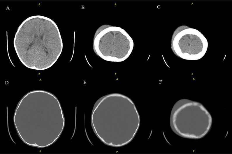 Noncontrast CT examination of the brain. Multiple axial images were obtained. Images listed from superior to inferior. Adjustment of the MA and/or KV was done according to the patient's size. Findings include right high convexity scalp soft tissue swelling without acute intracranial abnormality.
