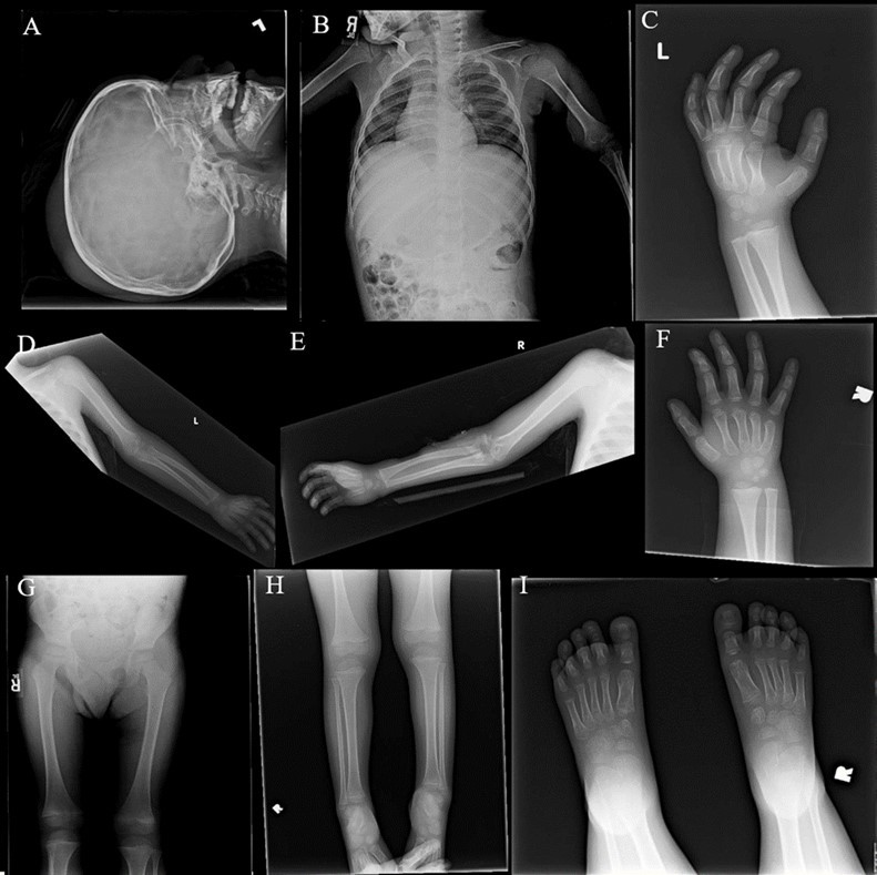X-Ray complete bone survey. 2A: Lateral view of the skull, 2V. 2B: Frontal view of chest, abdomen and pelvis (spine), 1V. 2C: Frontal view of left humerus, 2V. 2D: Frontal view of left hand, 2V. 2E: Frontal view of right humerus, 2V. 2F: Frontal view of right hand, 2V. 2G: Frontal view of both femora, 1V. 2H: Frontal views of both lower legs, 2V. 2I: Frontal views of both feet, 2V. Findings include calvarial soft tissue edema. No additional injury detected on these radiographs.
