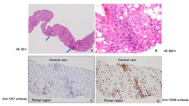 Pathological findings of the liver tissue biopsy. (A) Low-power field image of the HE-stained speci-men showing sporadic concentrations of inflammatory cells, indicating focal necrosis (HE 20×). (B)High-power field image showing concentrations of macrophages and lymphocytes. Denaturation of nuclei was ob-served in the surrounding hepatic cells (HE400×).(C)Immunostaining using anti-CK7 antibodies to identify biliary epithelial cells. The sites of focal necrosis were negative for CK7 and were not portal regions. (D)Immunostaining using anti-CD68 antibodies to identify macrophages. Accumulation of macrophages was ob-served around the central veins.