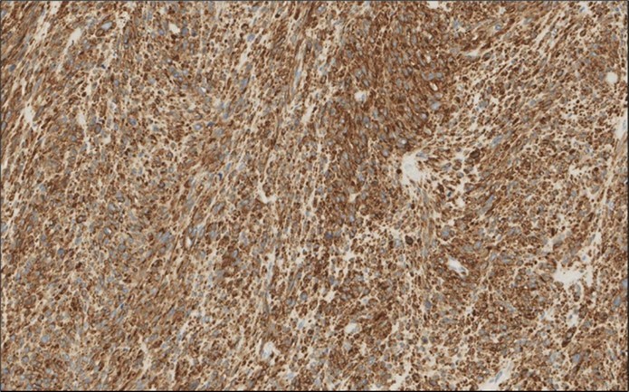 Left thyroid Cells are diffusely positive for Caldesmon immunohistochemistry (IHC, x200)