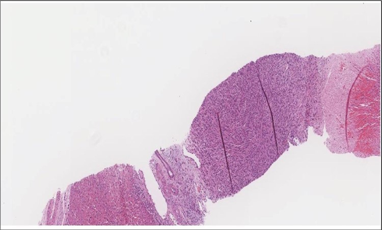 Liver Biopsy Higher power showing the metastatic foci is almost identical to what is seen in the thyroid with the highly atypical spindle cells. (H&E, ×200).