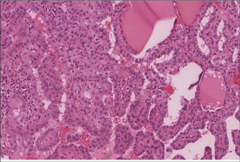 Right thyroid Higher power showing the characteristic nuclear features of papillary thyroid cancer nuclear enlargement, elongation and overlapping, chromatin clearing, margination and glassy nuclei. (H&E, ×200).