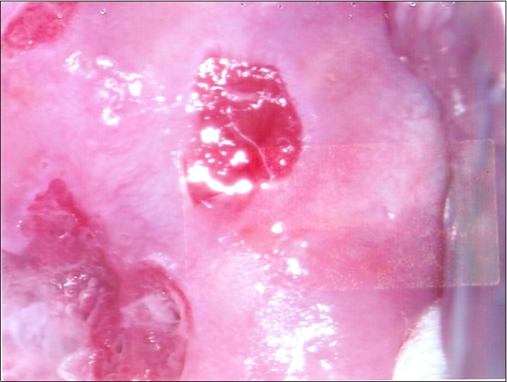 Repeat colposcopy (high magnification)