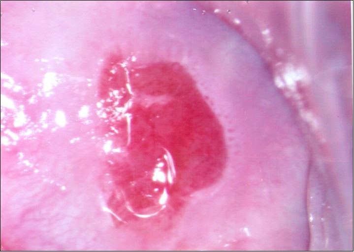 Repeat colposcopy (high magnification)