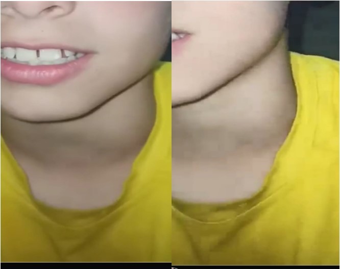(a Left, b Right) (a) obvious neck mass on regular speech, (b) huge mass during Valsalva maneuver