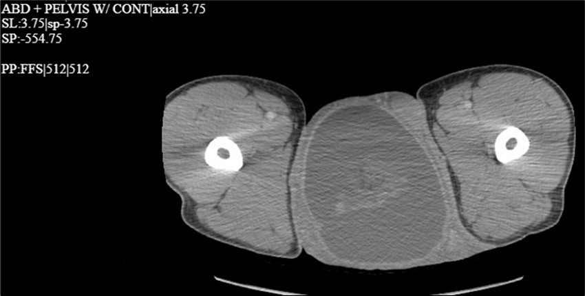 CT scan with contrast of the thigh region in the coronal plane with testicular swelling noted in between the thighs.