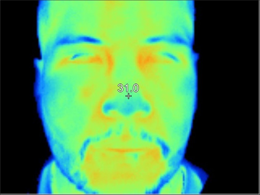 Thermography shows a similar temperature on both inner edges.