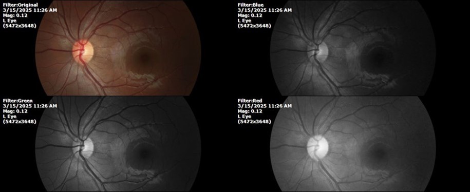The anatomy of the posterior pole of the left eye is preserved, without showing pathology data.