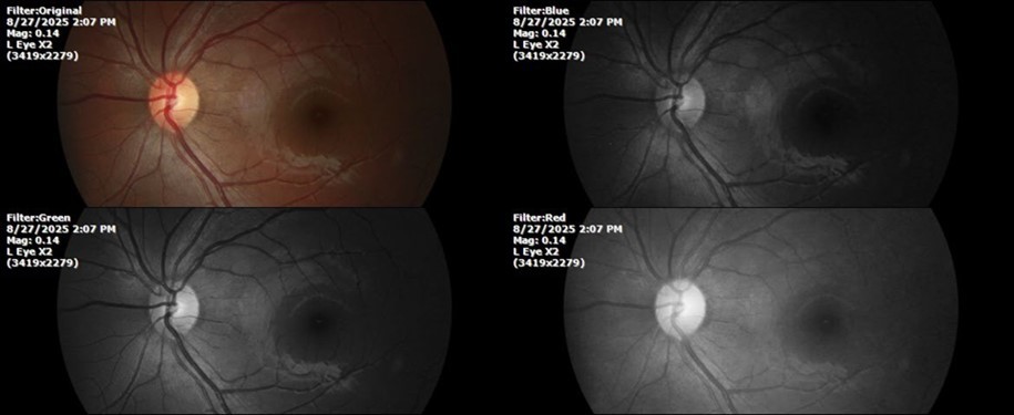 The retina, optic nerve, choroid, and macula of the left eye do not show any evidence of sympathetic ophthalmia.