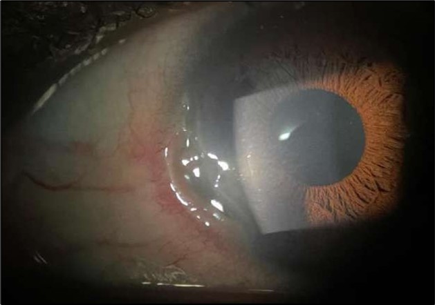 OS, Slit-lamp image after a course of intravenous methylprednisolone therapy showing marked reduction in conjunctival hyperemia and stromal infiltration.