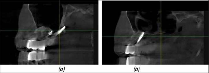 Implants in the palatal sinus cortical area to avoid bone grafting: (a) BCS implant partially fixed in the graft material mass, partially in the palatal cortex; (b) Implant fixed in the palatal cortex at the junction with the nasal cortex, behind the graft material mass.
