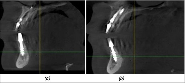 Corticobasal BCS implants fixed between the vestibular and lingual cortices with support on the basal bone: (a) BCS fixed between the lateral cortices; (b) BCS implant with support on the basal cortex.