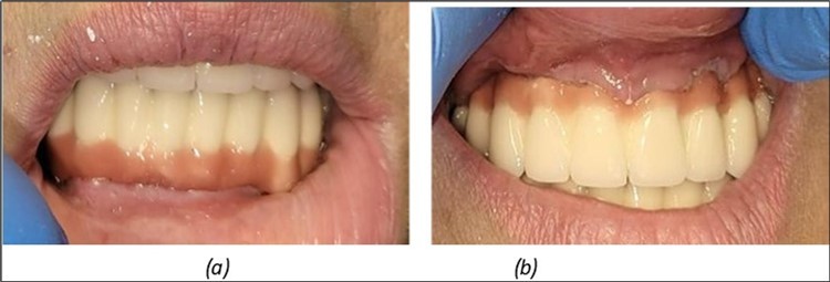 Definitive metal-ceramic prosthetic restoration cemented 4 days postoperatively: (a) Junction area at the mandible between the definitive metal-ceramic prosthetic restoration and the gingiva; (b) Junction area at the maxilla