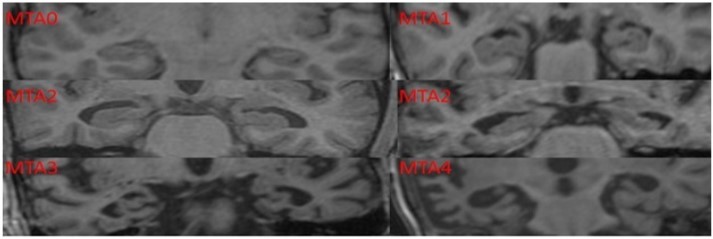 Scheltens Visual Rating Scale used in the current study to assess the medial temporal lobe atrophy rating scores.