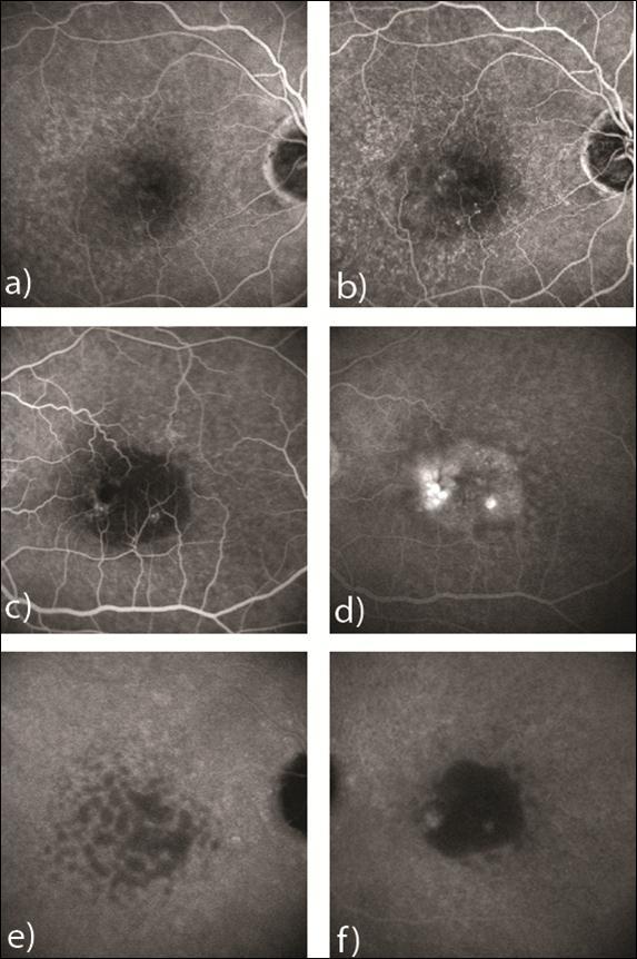 a) early phases fluorescein angiography of the right eye at the time of diagnosis; b) early phases fluorescein angiography of the right eye 6 months later; c) early and d) late phases fluorescein angiography of the left eye at the time of diagnosis; late phases indocyanine angiography of the right (e) and the left (f) eye
