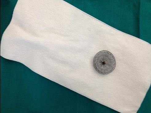 Nitinol occluder system (Amplatzer®)