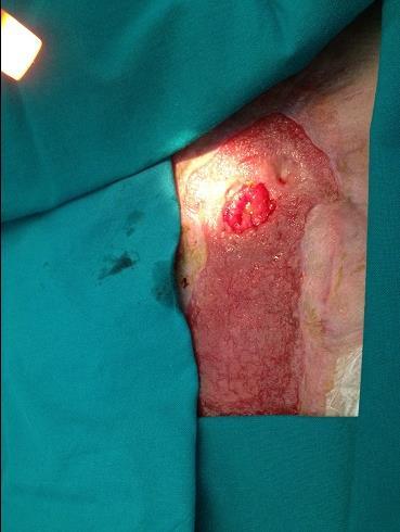 Enteroatmospheric fistula