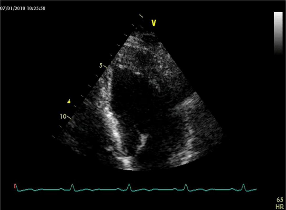 Echocardiogram image of non classical apical hypertrophic cardiomyopathy of the patient.