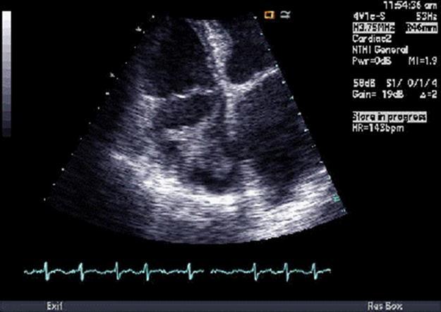 Echographic image of Case 2 of the large, mobile thrombus in the right atrial cavity.