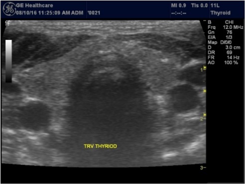 Normal thyroid gland transverse view