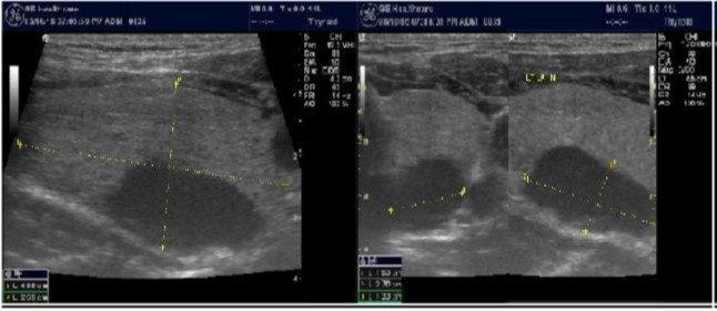 Nodule that proven to be a parathyroid adenoma, volume =5265 mm3