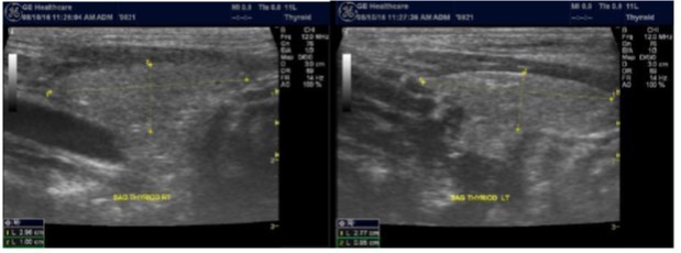 Normal thyroid gland long view
