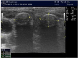Isoechoic nodule with Hyperechoic rim