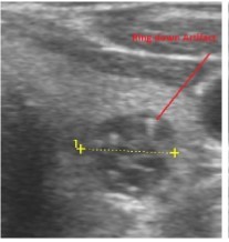 Ring down artifact of colloid nodule