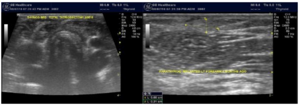 Total thyroidecotmy and forearm implantation of the parathyroid gland