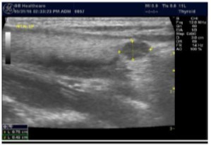 Thyroid nodule suspicious for Parathyroid adenoma due to its location