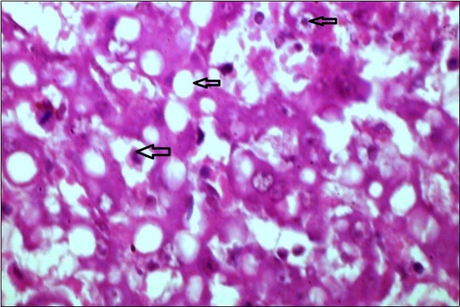liver (dead cattle less than 1 year old) showed hepatocytes suffering hydropic degeneration. And necrosis (H&E, X 60).
