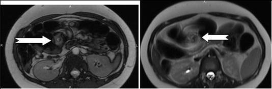 Axial contrast-enhanced MRI scans show characteristic whirpool appearance of bowel and mesentery wrapping around superior mesenteric artery
