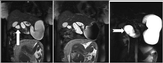 Coronal reformatted image shows contrast agent–filled small bowel on right