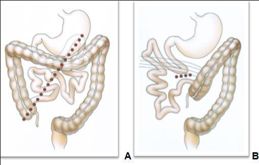 —Schematic drawings of normal rotation and malrotation (from Pickhart et Bhalla, 2002). A, Drawing shows that normal 270° rotation and fixation of midgut results in familiar positioning of bowel with broad mesenteric attachment (dotted line). B, Drawing shows that malrotation results in malpositioned bowel and narrow base of mesenteric fixation (dotted line), which is prone to midgut volvulus. Abnormal fibrous peritoneal bands of Ladd (curved lines) that attach to right colon predispose to internal hernia in older patients.