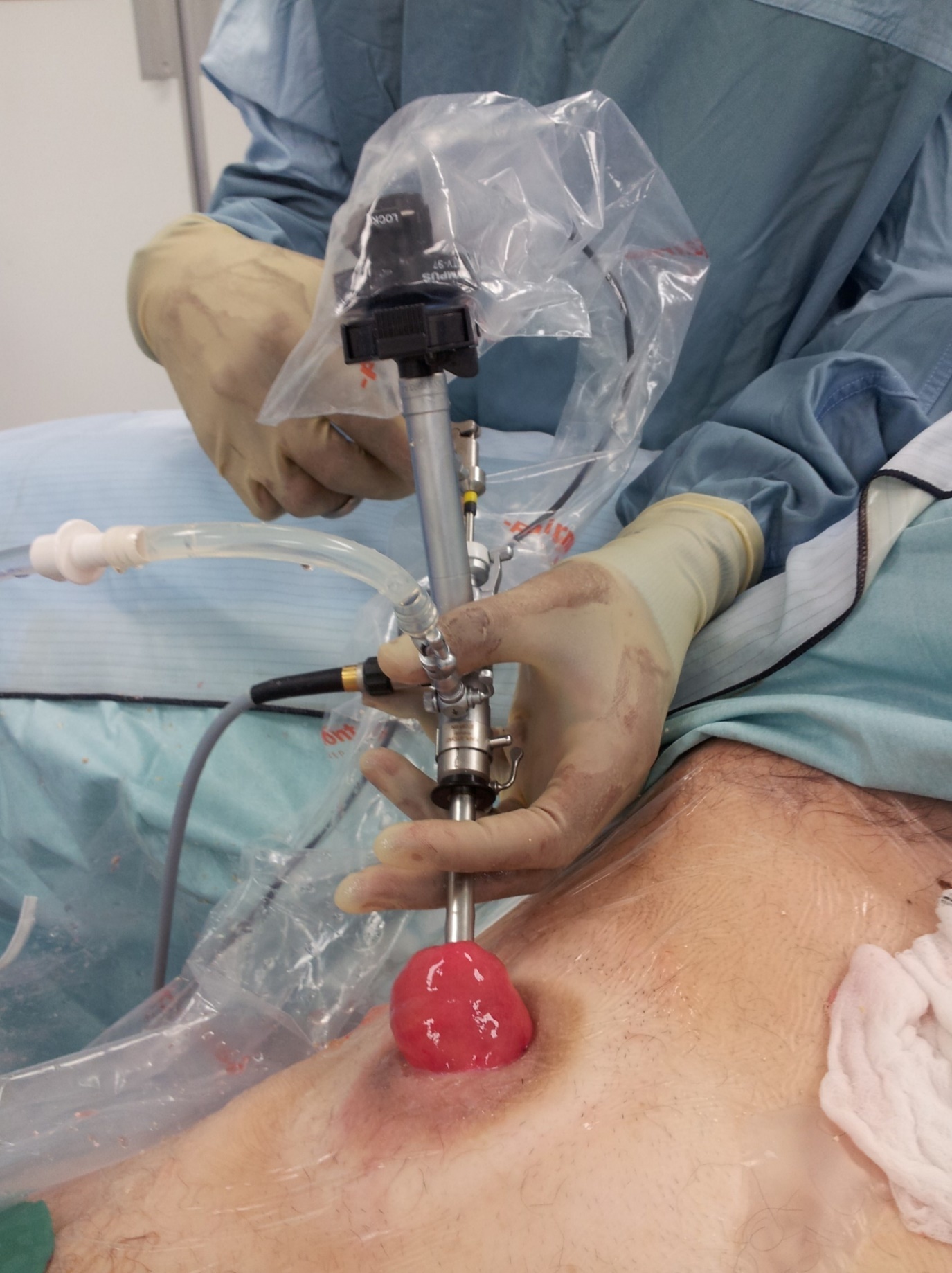 Nephroscopy in the conduit