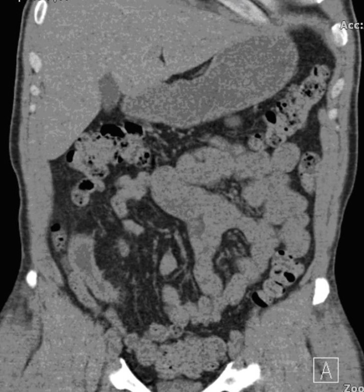 Post-operative CT scan revealing a stone free ileal conduit.