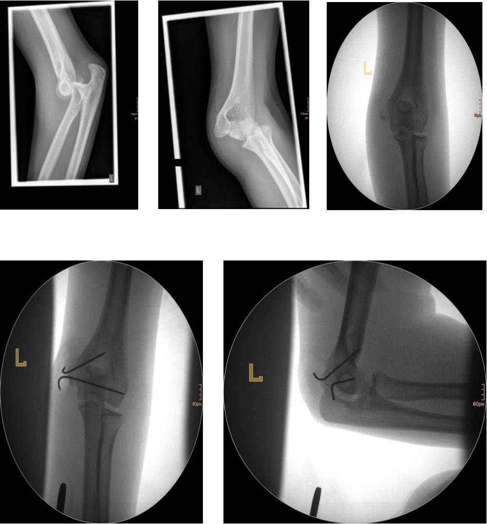 14 year old female patient with a elbow dislocation and a dislocated left epicondyle fracture which was treated by open reduction and osteosynthesis with two divergent Kirschner wires (personal collection)