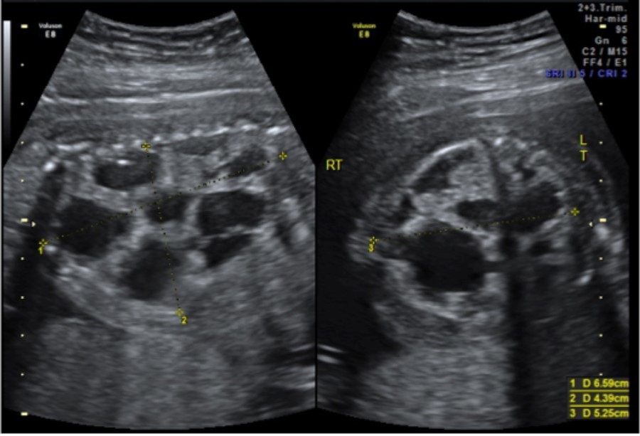 CPAM noted at initial fetal surgery consultation; sagittal view on the left and transverse view on the right