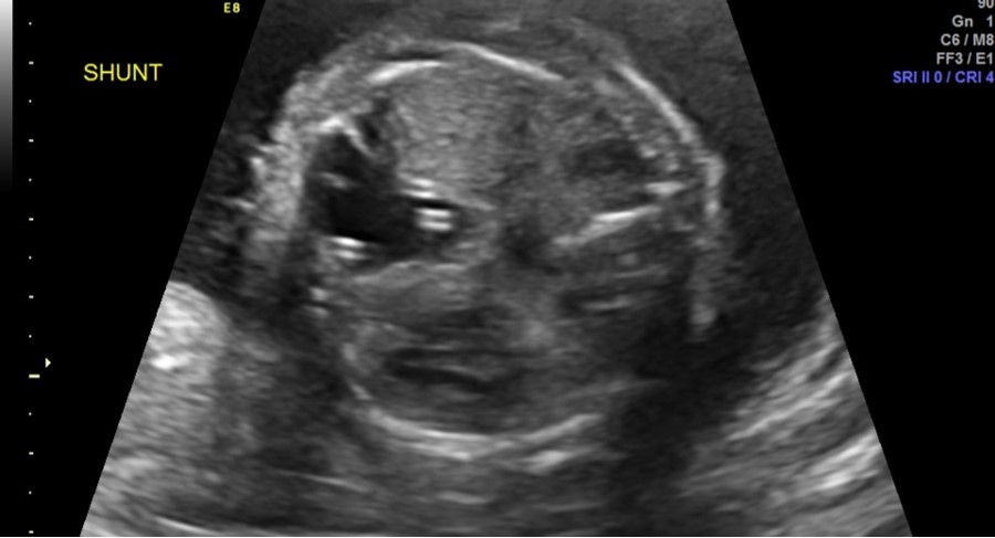 Two thoraco-amniotic shunts can be seen in the dominant CPAM cyst