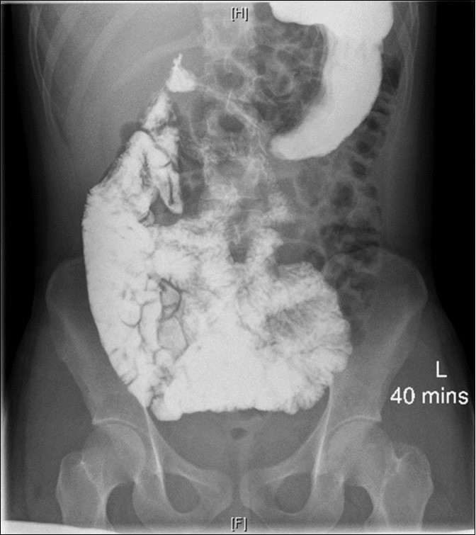 UGIS showing malrotation