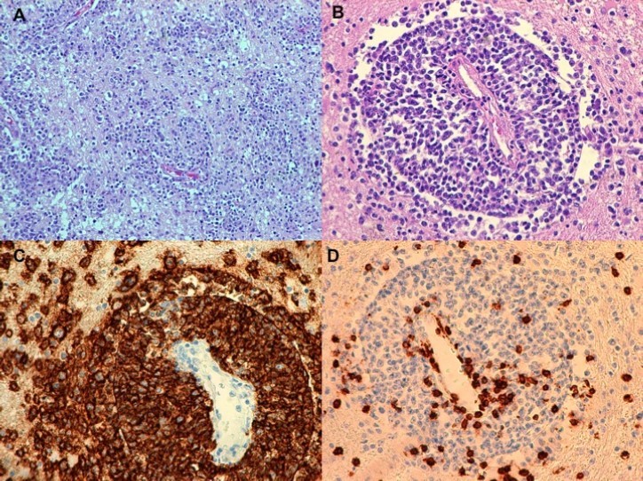 Histopathological findings . (A,B) and immunohistochemical reactions (IHC) (C,D) of diffuse large B-cell lymphoma, not otherwise specified (DLBCL, NOS) with secondary involvement of white matter. A. Infiltration composed of medium-sized lymphoid cells in the brain tissue without marked necrosis and with a focal infiltration around small blood vessels (HE,100x). B. Infiltration consisting of DLBCL, NOS cells around a small blood vessel (HE,200x). C.D. IHC reactions: CD20(+) in the majority of DLBCL, NOS cells surrounding the lumen of a small blood vessel (C.200x) and CD3(+) in few isolated normal T-cells (D.200x).