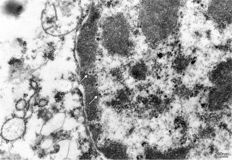 Additional examinations of post-mortem biopsy material - transmission electron microscopy. Electron micrograph presenting virus-like particles randomly distributed in the perinuclear space of infected oligodendrocyte (arrows). Spherical electron-dense centre and electron-lucent viral envelope is visible. The size of the particles, 35 to 45 nm, is typical for JC viruses.