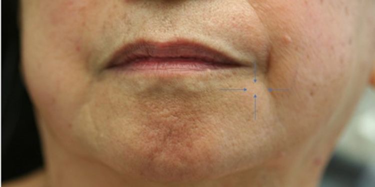 Article: Hemangioma of the Buccal Mucosa of the Cheek Presenting as a Dermoid Cyst: A Case Report 